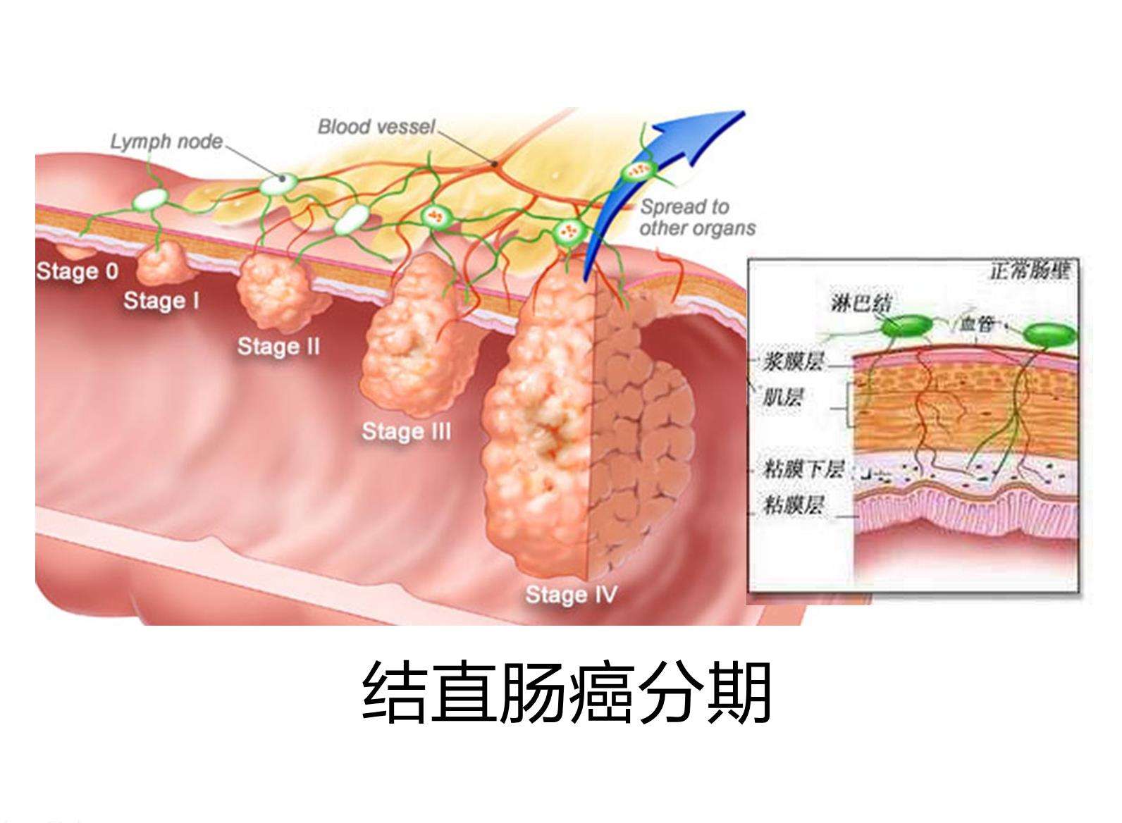 警惕直肠癌早期的5个症状