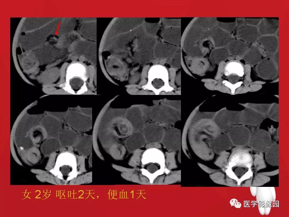 肠套叠的ct诊断