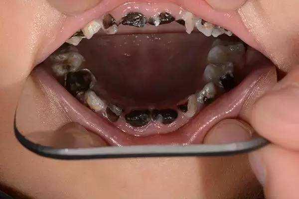 天啊4岁孩子一次性拔除13颗龋齿孩子的牙齿该如何保护