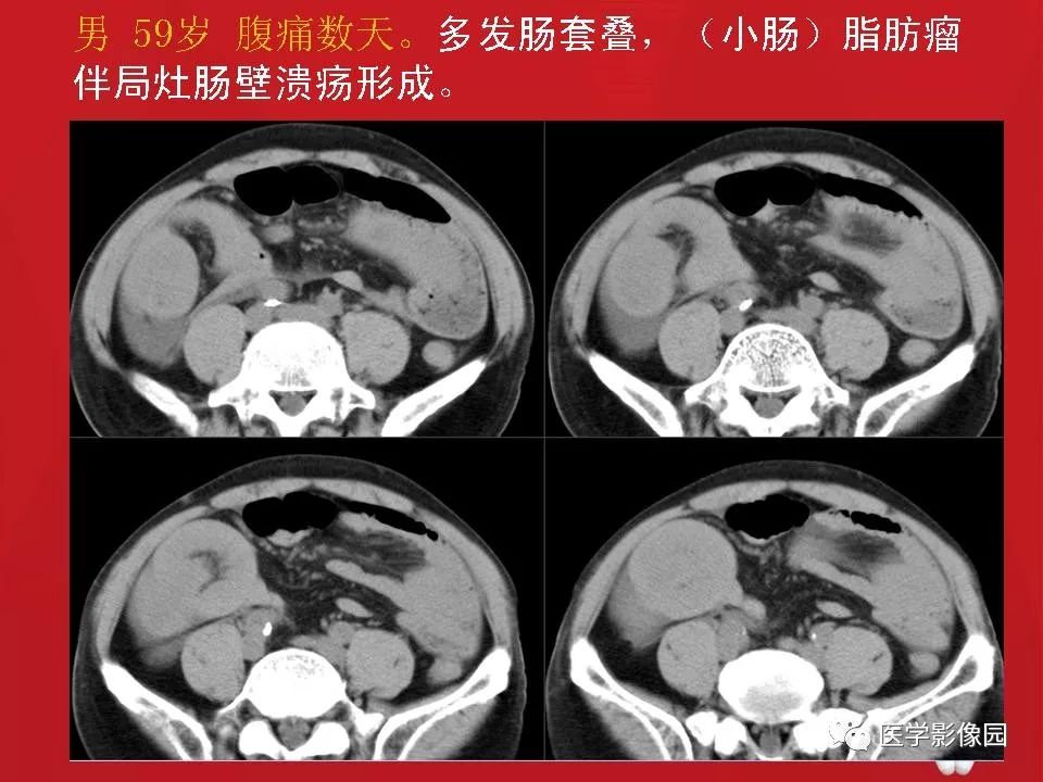 肠套叠ct表现图片大全图片