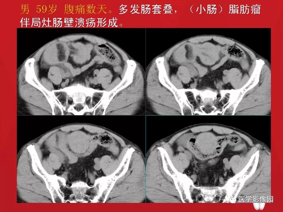 肠套叠ct表现图片大全图片