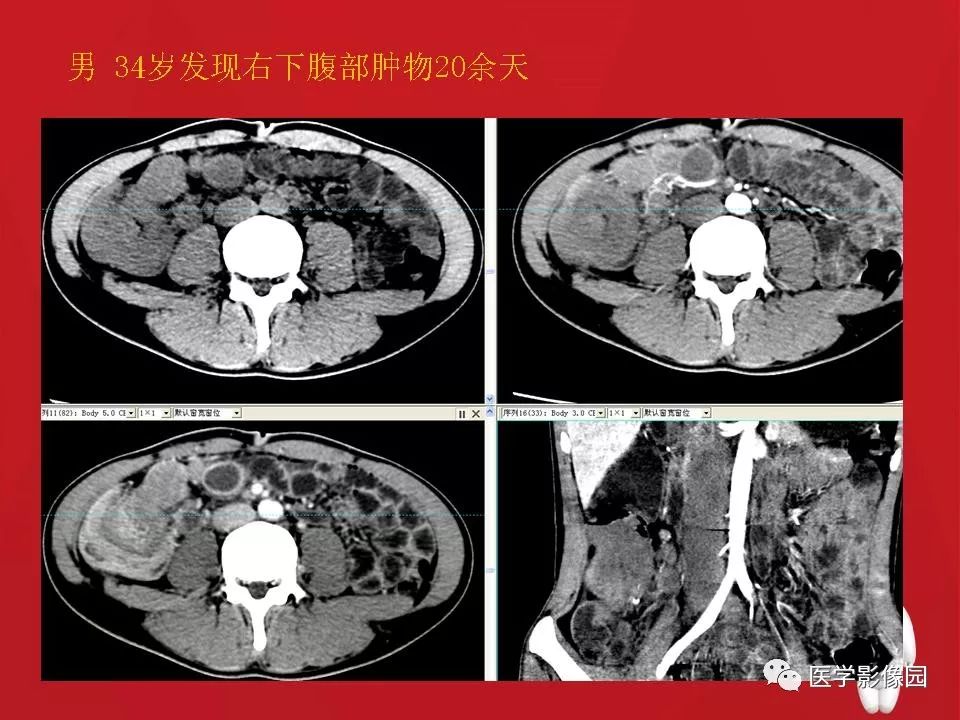 肠套叠ct图片