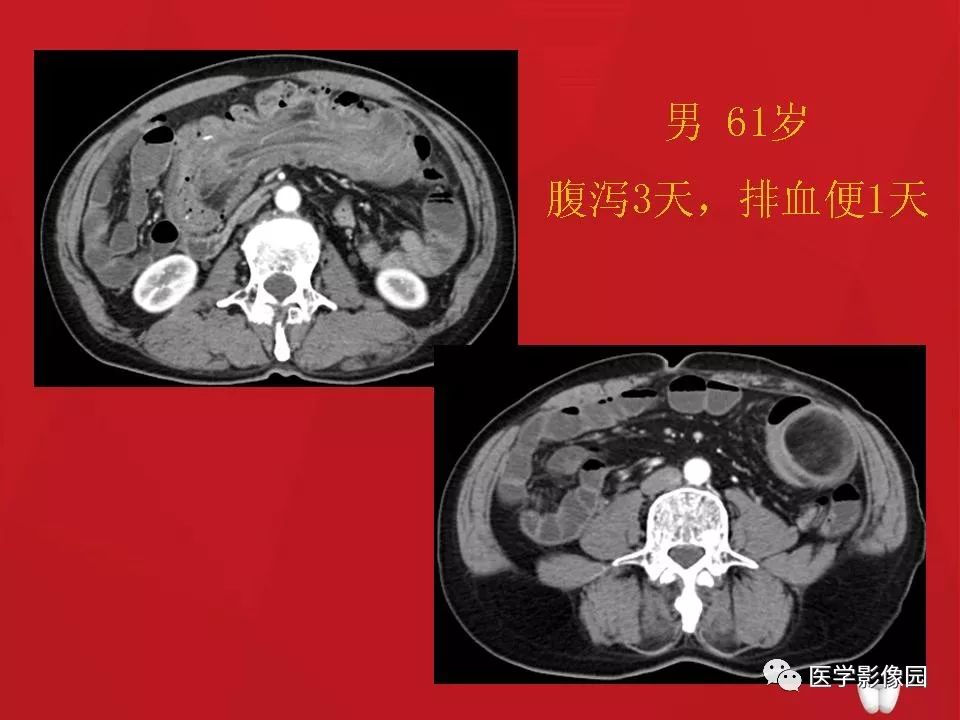 肠套叠ct表现图片大全图片