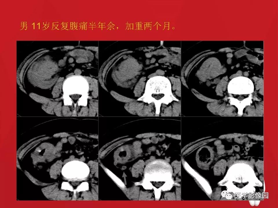 肠套叠的ct诊断