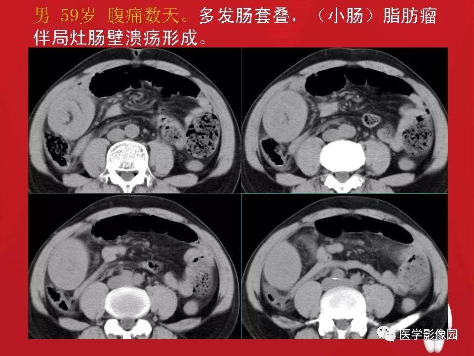 肠套叠ct表现图片大全图片