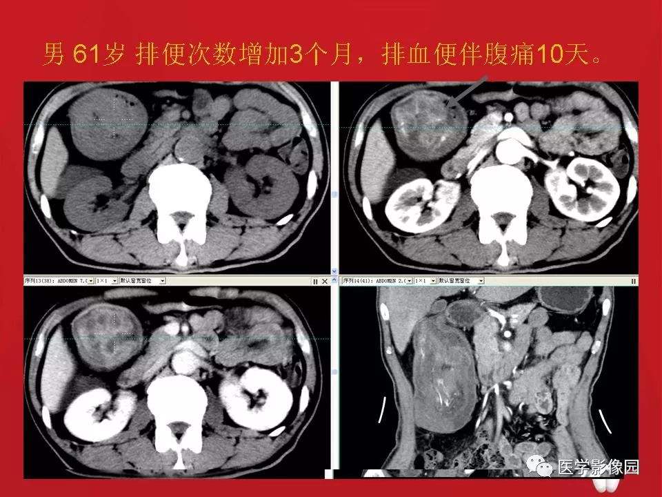 肠套叠ct表现图片大全图片