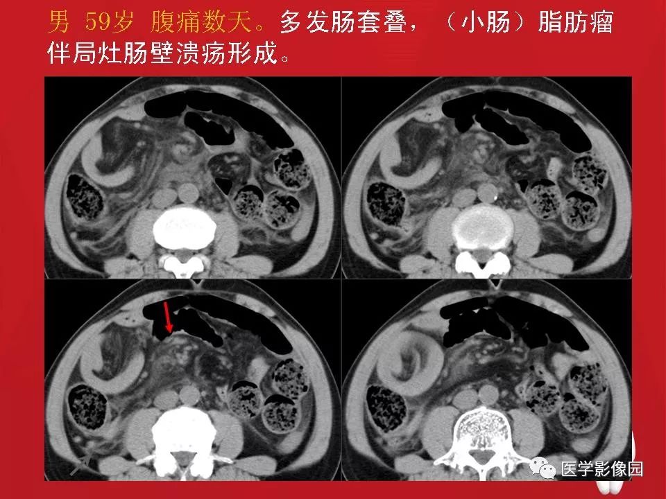 肠套叠图片影像图片图片