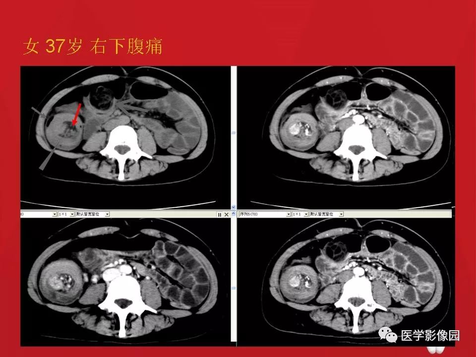 肠套叠的ct诊断