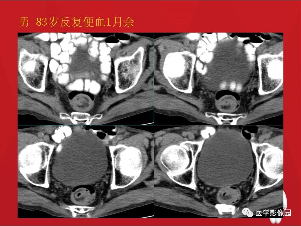 肠套叠的ct诊断