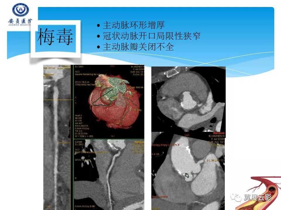 【专家课堂】冠状动脉狭窄的鉴别诊断