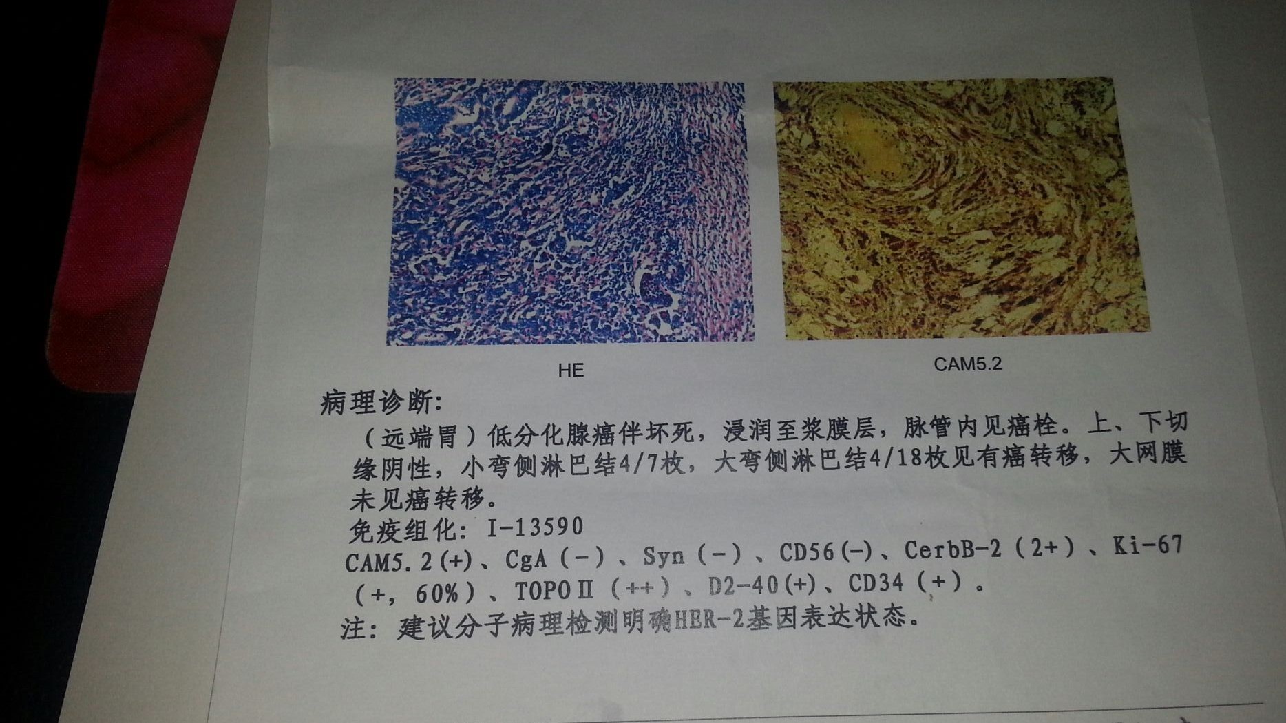 23岁小伙得胃癌