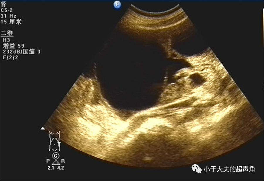 粘液性囊腺瘤超声图片