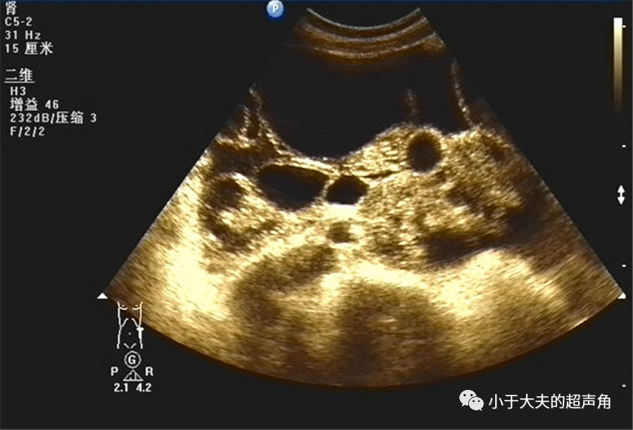 粘液性囊腺瘤超声图片