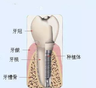 种植牙三期图解 步骤图片