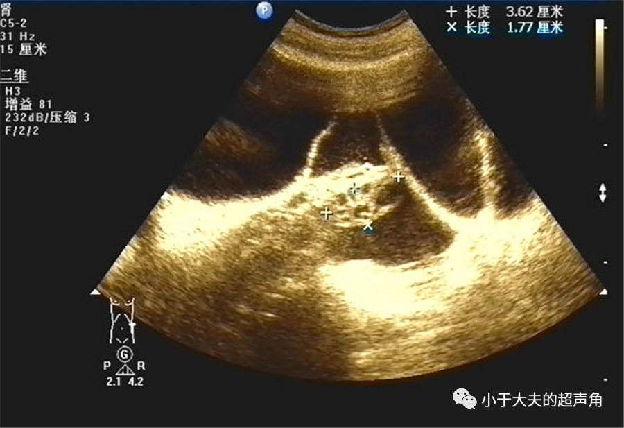 粘液性囊腺瘤超声图片