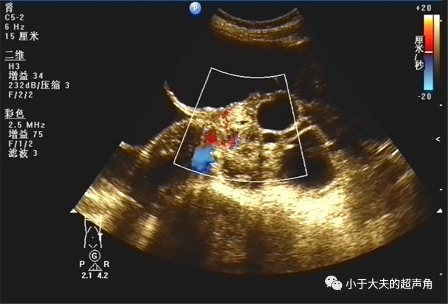 粘液性囊腺瘤超声图片