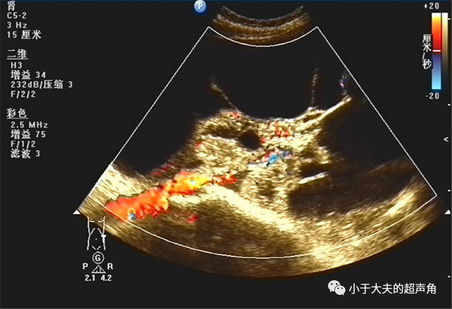 粘液性囊腺瘤超声图片