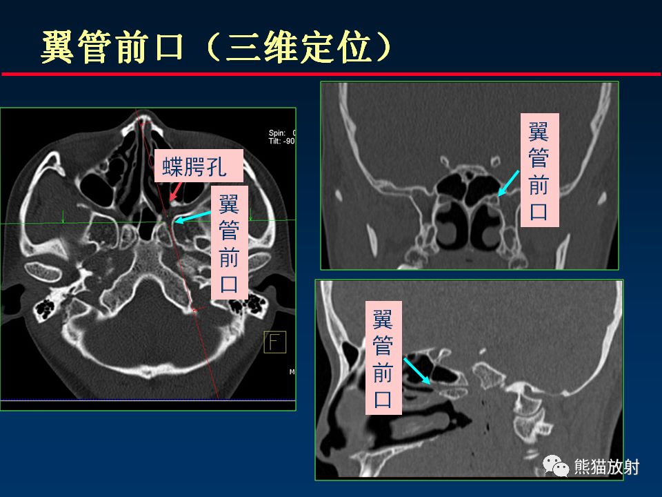 柳澄講壇顱底重要ct解剖及其臨床意義