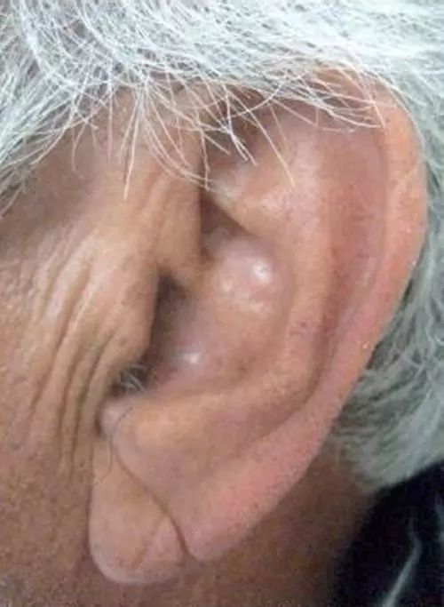 在耳垂上出现一条斜线或褶皱,被称为耳褶心征,很可能是冠状动脉硬化