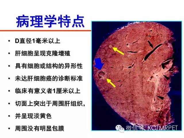 肝硬化结节的病理与影像学表现