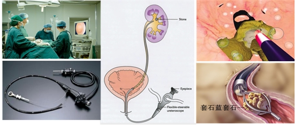 手術無創,保護腎臟無損傷:纖維腎鏡經人體泌尿系統自然通道進入輸尿管