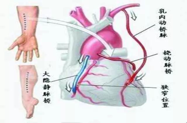 心脏搭桥图片 示意图图片