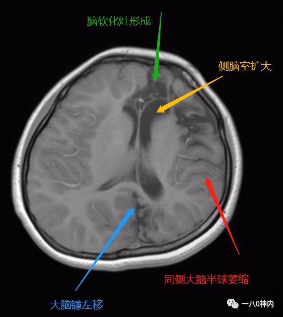 均诊断为"继发性癫痫(病因不明)2,腺样体肥大;1,左额枕顶叶脑软化灶