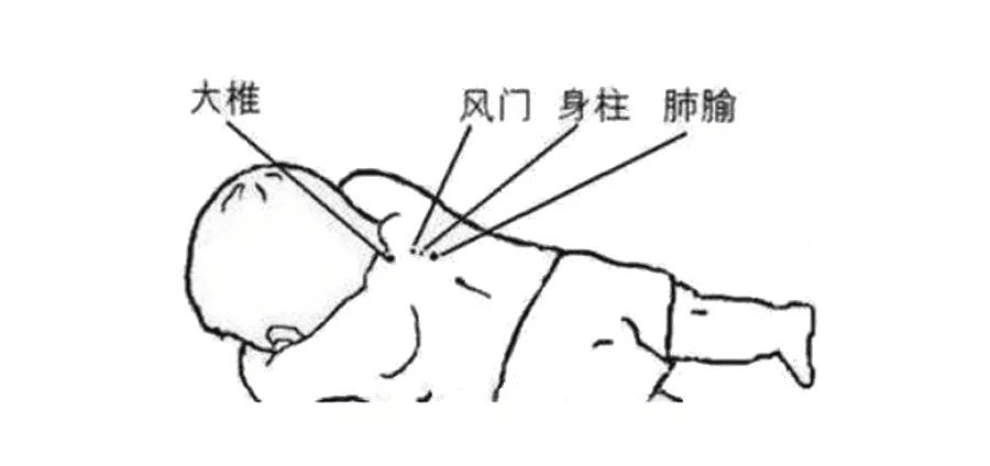 一:退烧艾灸取穴:大椎穴,身柱穴,肺俞穴