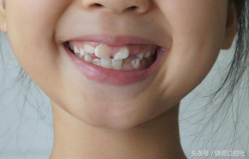 七岁小孩换牙后牙齿长歪了怎么办