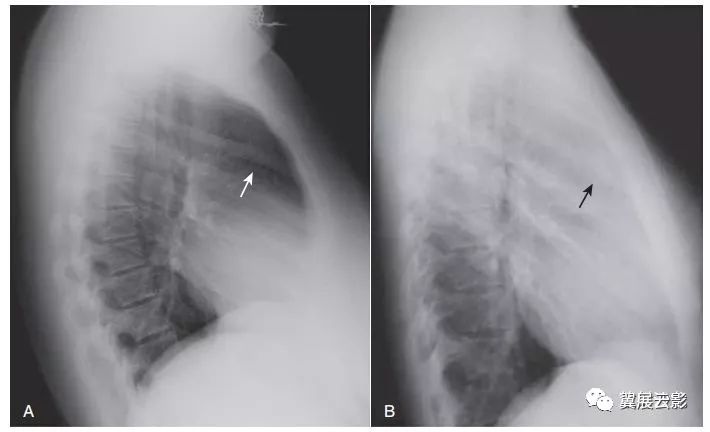 x线侧位胸片的5个关键区域