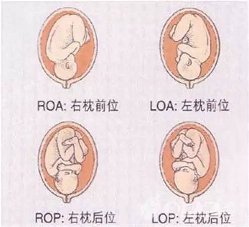 肩先露有四种胎位 左肩前(lsca 左肩后(lscp 右肩前(rsca 右肩后