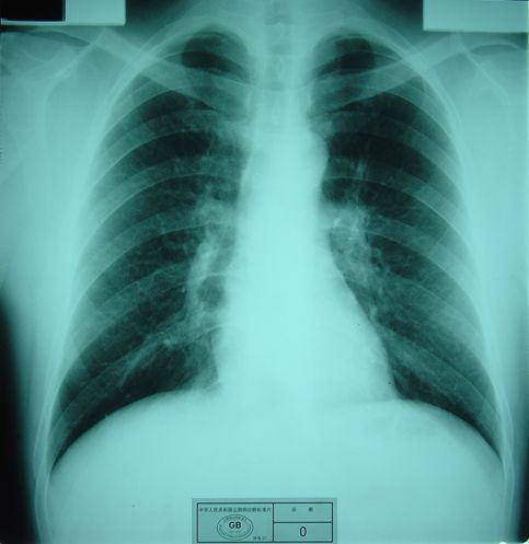 矽肺x线胸片图片图片