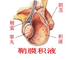 鞘膜积液外观图片图片