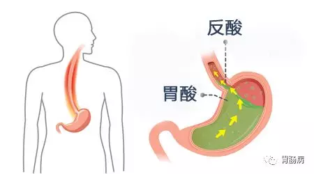 食管反流胸疼的位置图图片