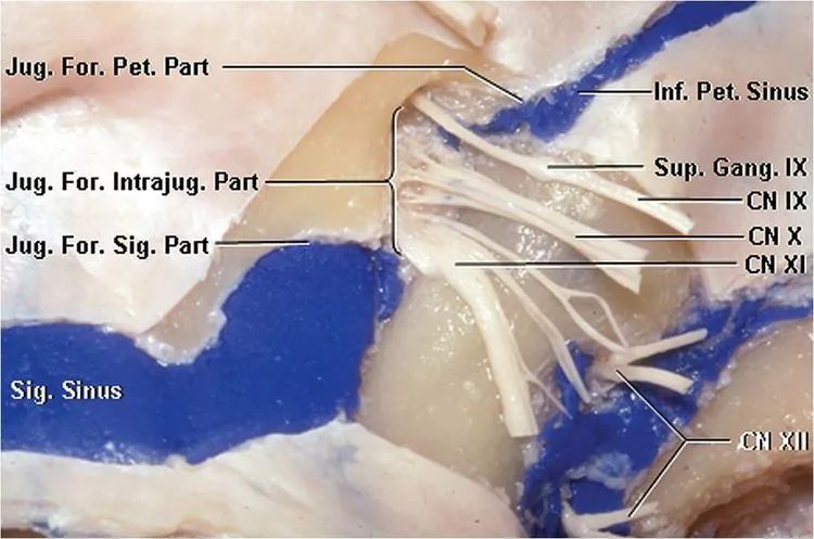 颈静脉孔区解剖彩图图片