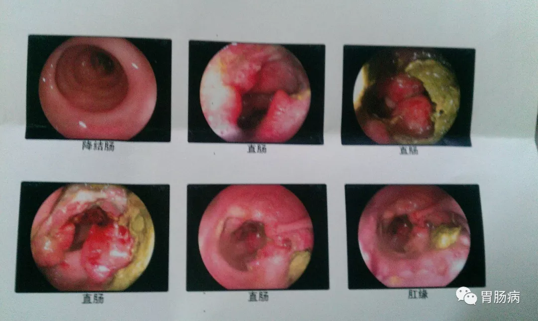 乙状结肠息肉癌症图片图片