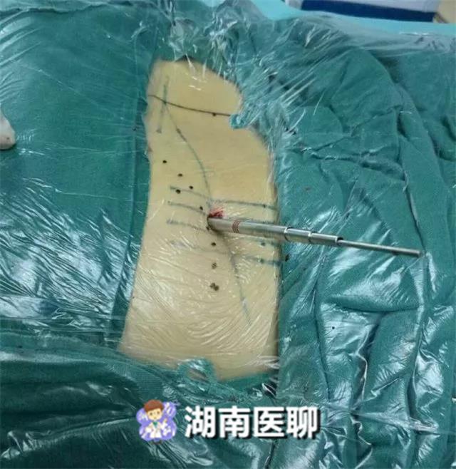 男子腰椎間盤突出疼痛難忍,做完手術2小時竟能下床活動!