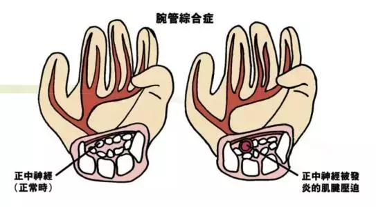 手臂突然发麻暗示心脏疾病 这9种人要当心了