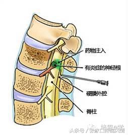 终板炎是什么病图片