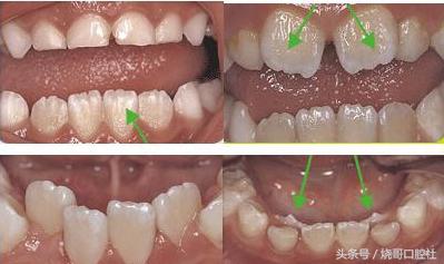 6歲孩子掉了乳牙2個多月都沒長恆牙這是怎麼回事
