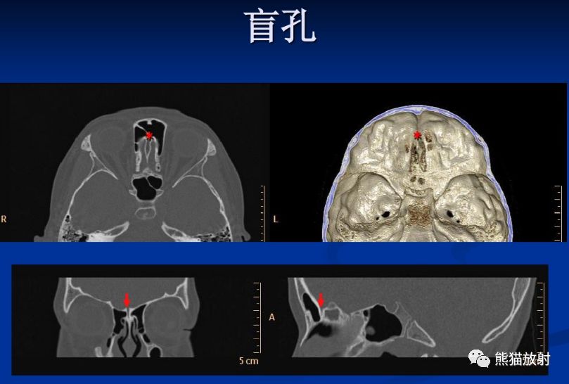 解剖丨颅底孔道及内容物