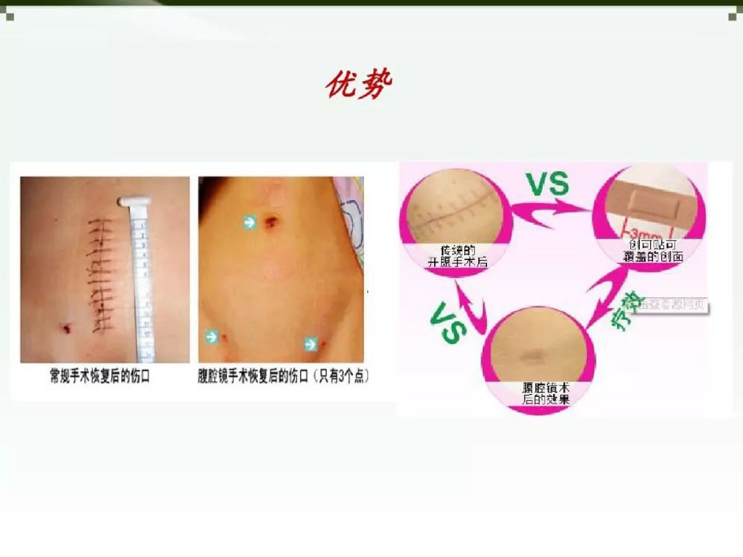 腹腔镜辅助下阴式全子宫切除术的手术护理查房