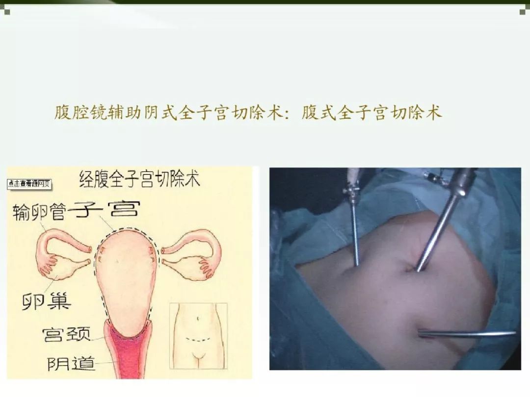 腹式全子宫切除术步骤图片