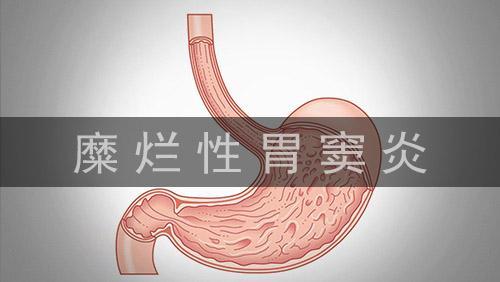 慢性糜爛性胃竇炎需及早治療做到這幾點可切斷胃糜爛的發生