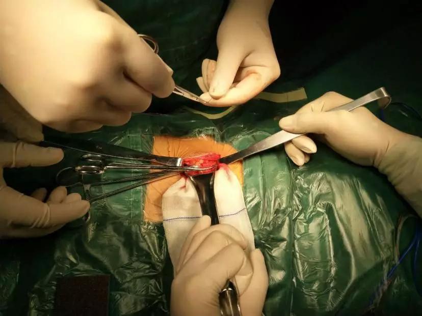 阑尾炎穿孔图片手术图片