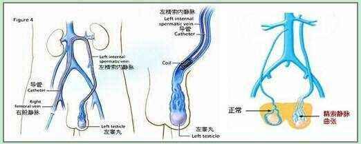 孩子两年怀不上,原来是精索静脉曲张惹的祸!