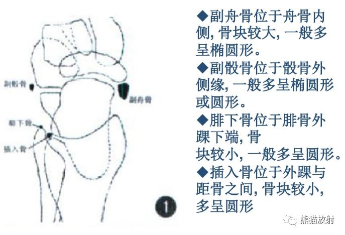 籽骨副骨永存骨骺撕脫骨折讀完此文你就懂了