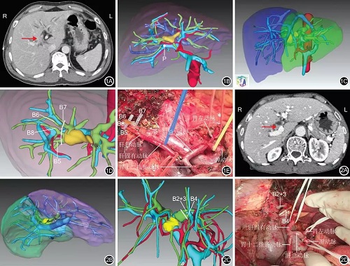 福建醫科大學孟超肝膽醫院發表肝門部膽管癌術前三維重建及虛擬手術