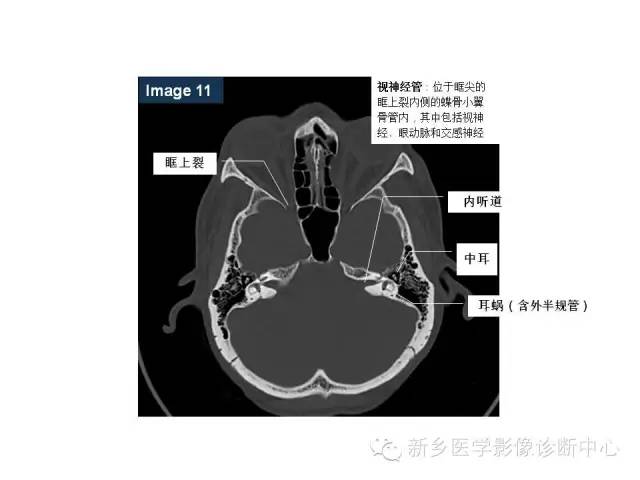 颅底孔道解剖详解