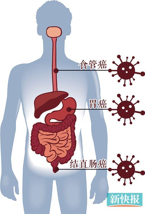 大肠癌好发部位图片